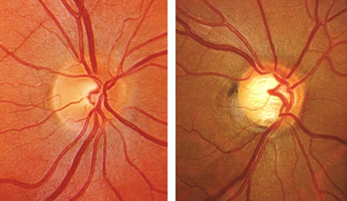 what-is-glaucoma-pietermaritzburg-eye-hospital